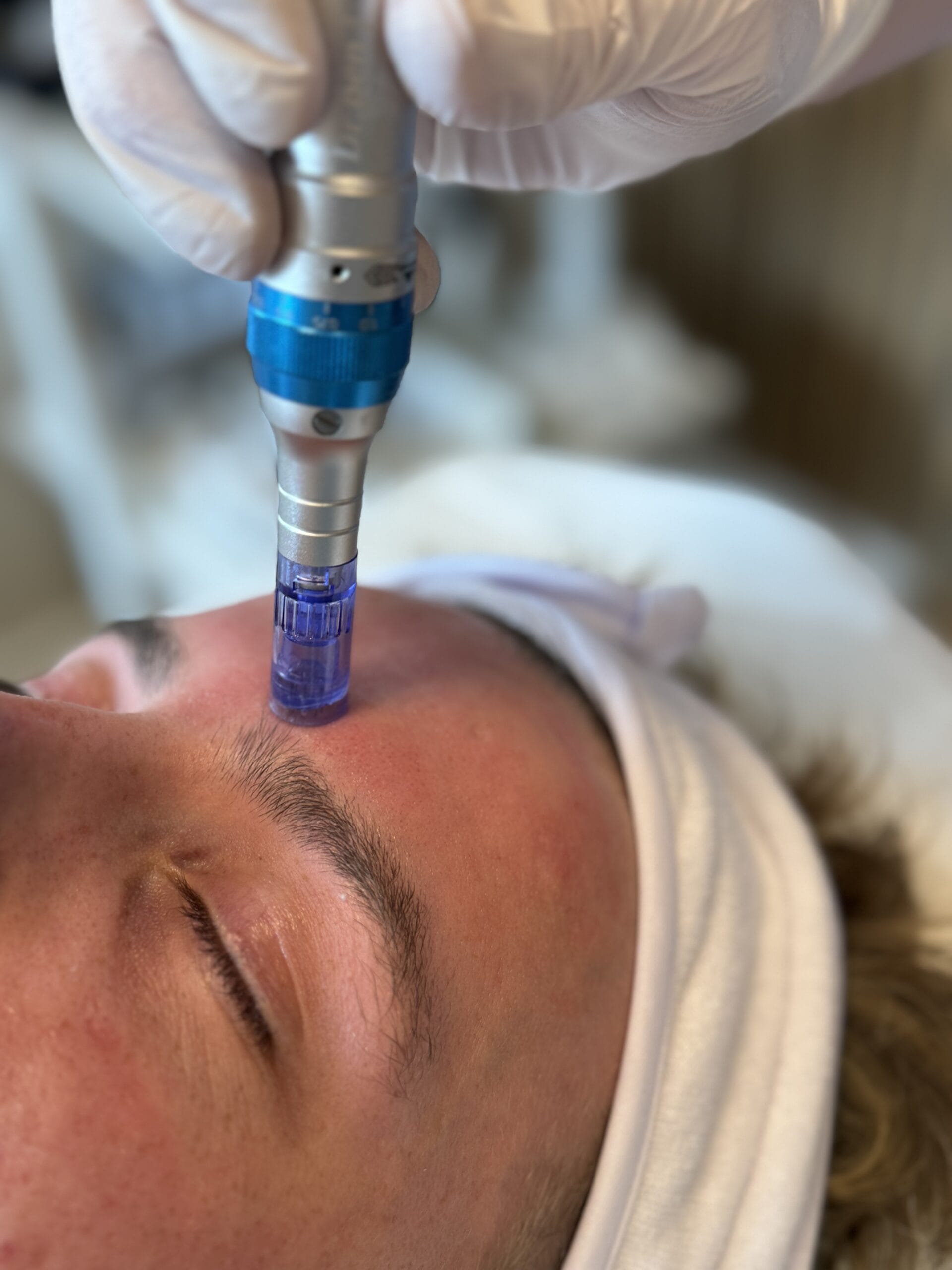Microneedling myter: Sandheder og misforståelser om hudens bedste ven